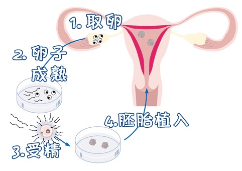 供卵试管代生